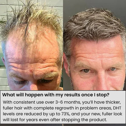 نظام ألفا إنفيوز لإعادة نمو الشعر