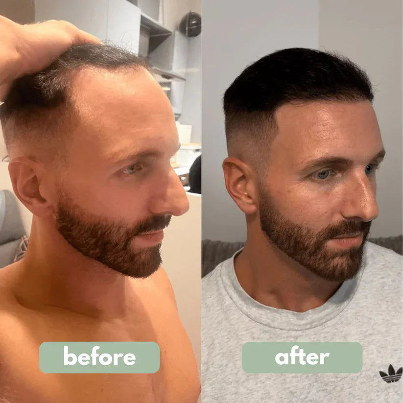 🚀 Reverse™ | سيروم نمو الشعر