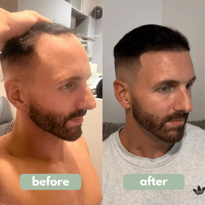 🚀 Reverse™ | سيروم نمو الشعر